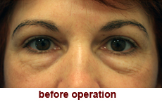 plastic-surgery-blepharoplasty